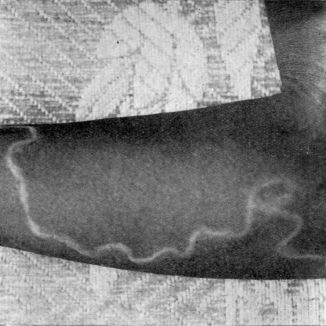 Vlasovec medinský pod kožou predlaktia